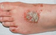 EPO has been a traditional remedy for eczema since ages (Image via Verywell Health)